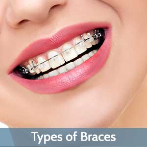 Types of Braces near Central Omaha