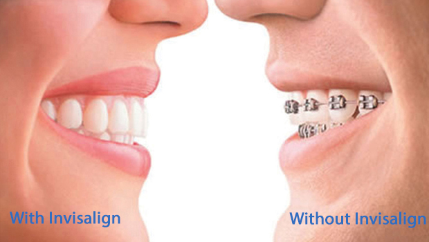 West Omaha Invisalign