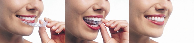 Invisalign in Central Omaha